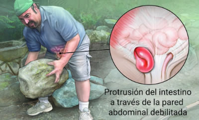 hernia inguinal2